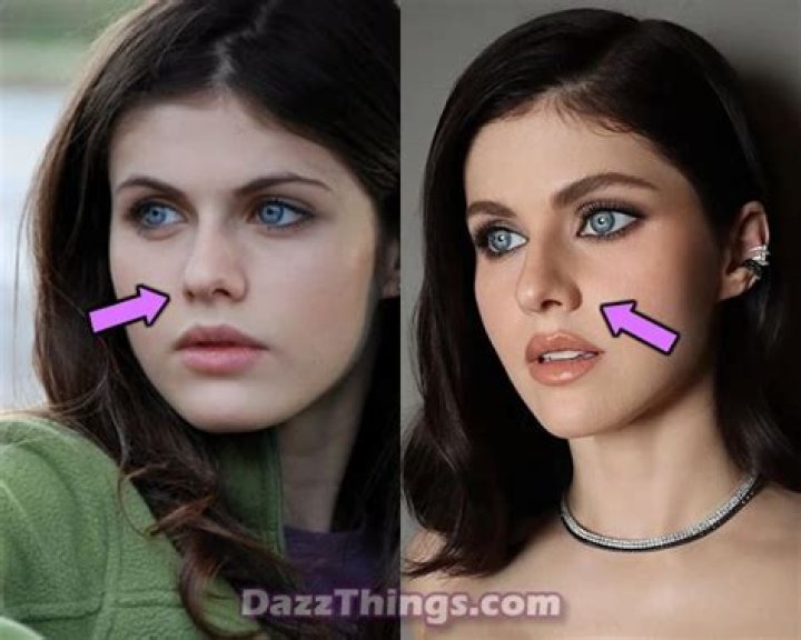 Did Alexandra Daddario Get Her Nose Done? Before And After Photos