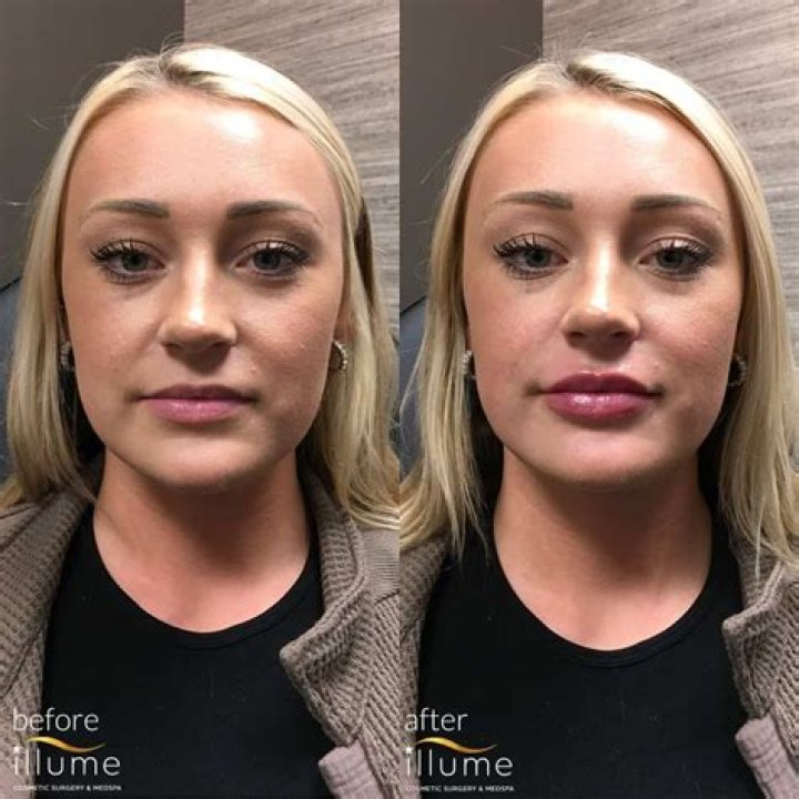 Did The Perfect Match Actress Get Lip Surgery Done?