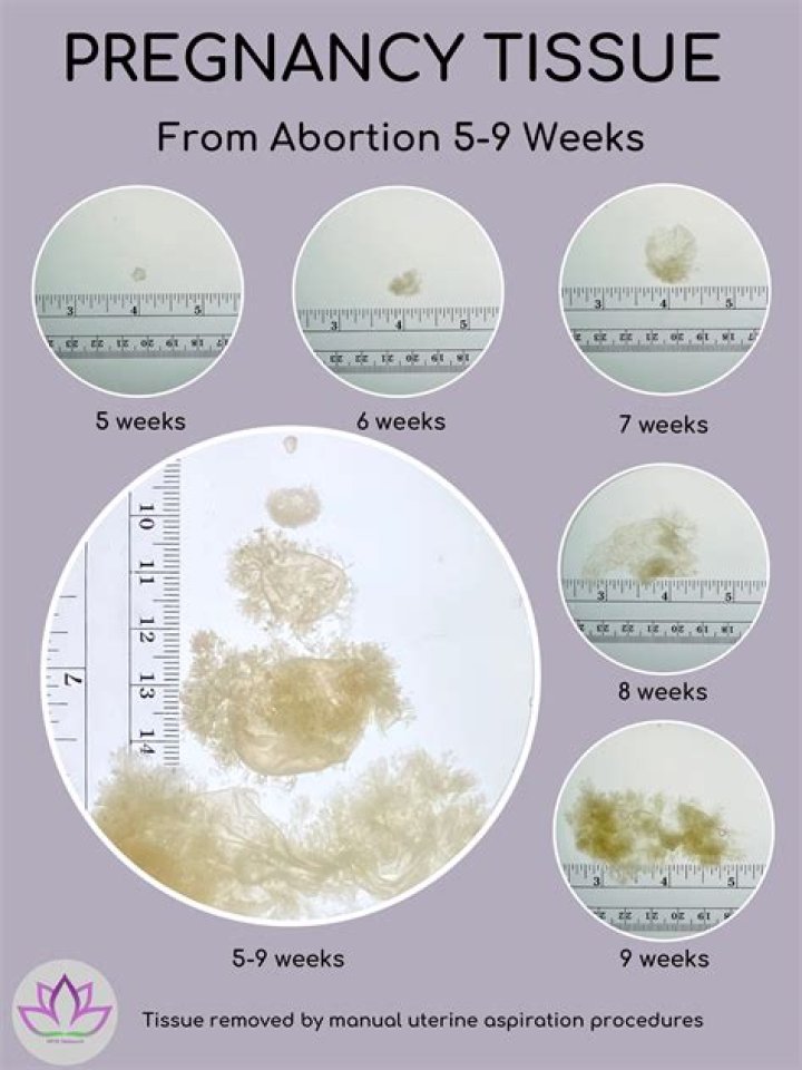 Miscarriage At Eight Weeks Pregnancy